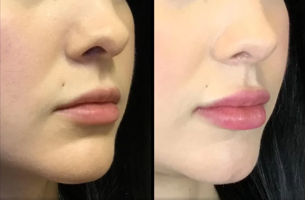 BellaFill Before and After Photo by Dr. Hernandez in San Antonio Texas