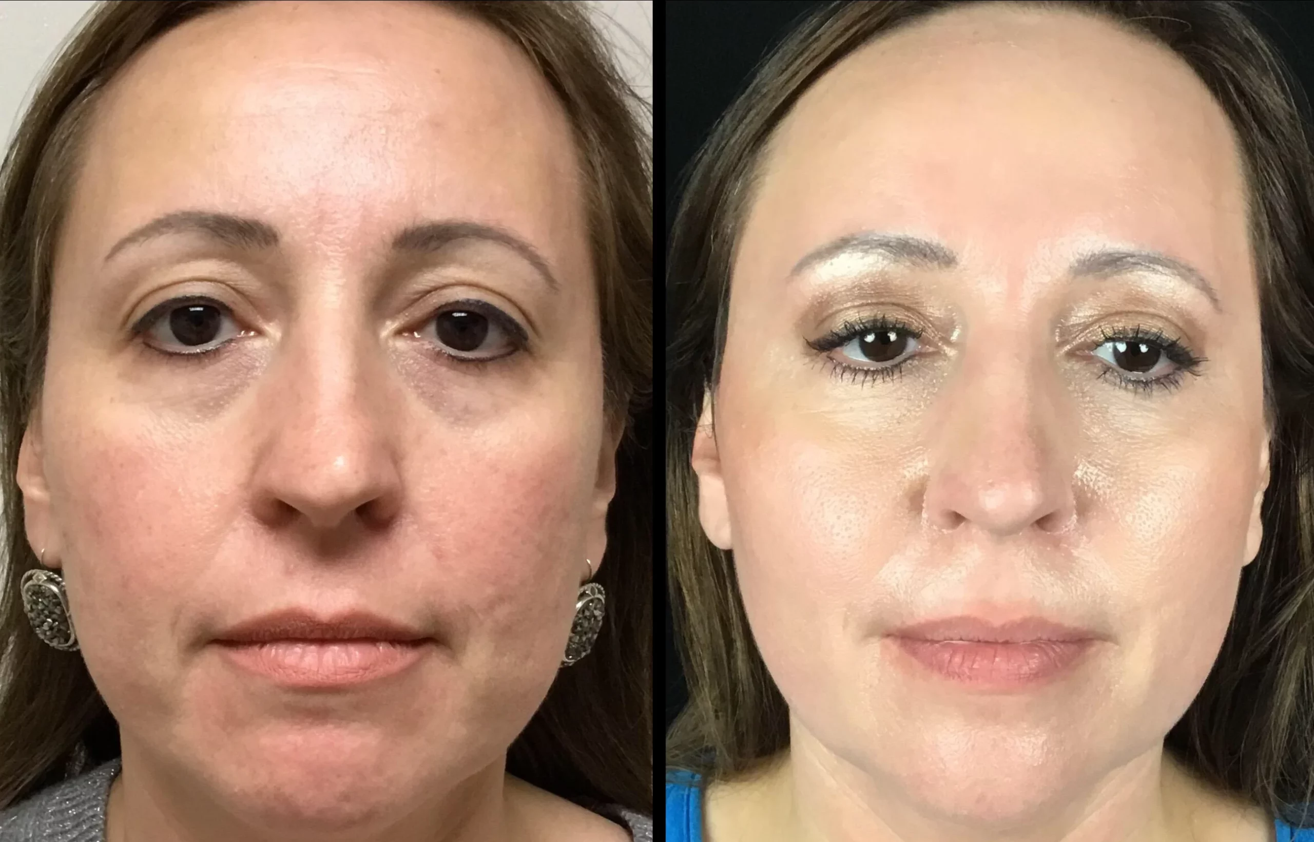 BellaFill Before and After Photo by Dr. Hernandez in San Antonio Texas