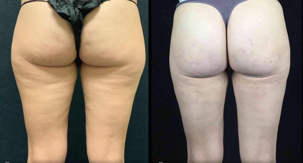 Cellfina Before and After Photo by Dr. Hernandez in San Antonio Texas
