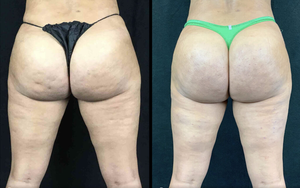 Cellfina Before and After Photo by Dr. Hernandez in San Antonio Texas