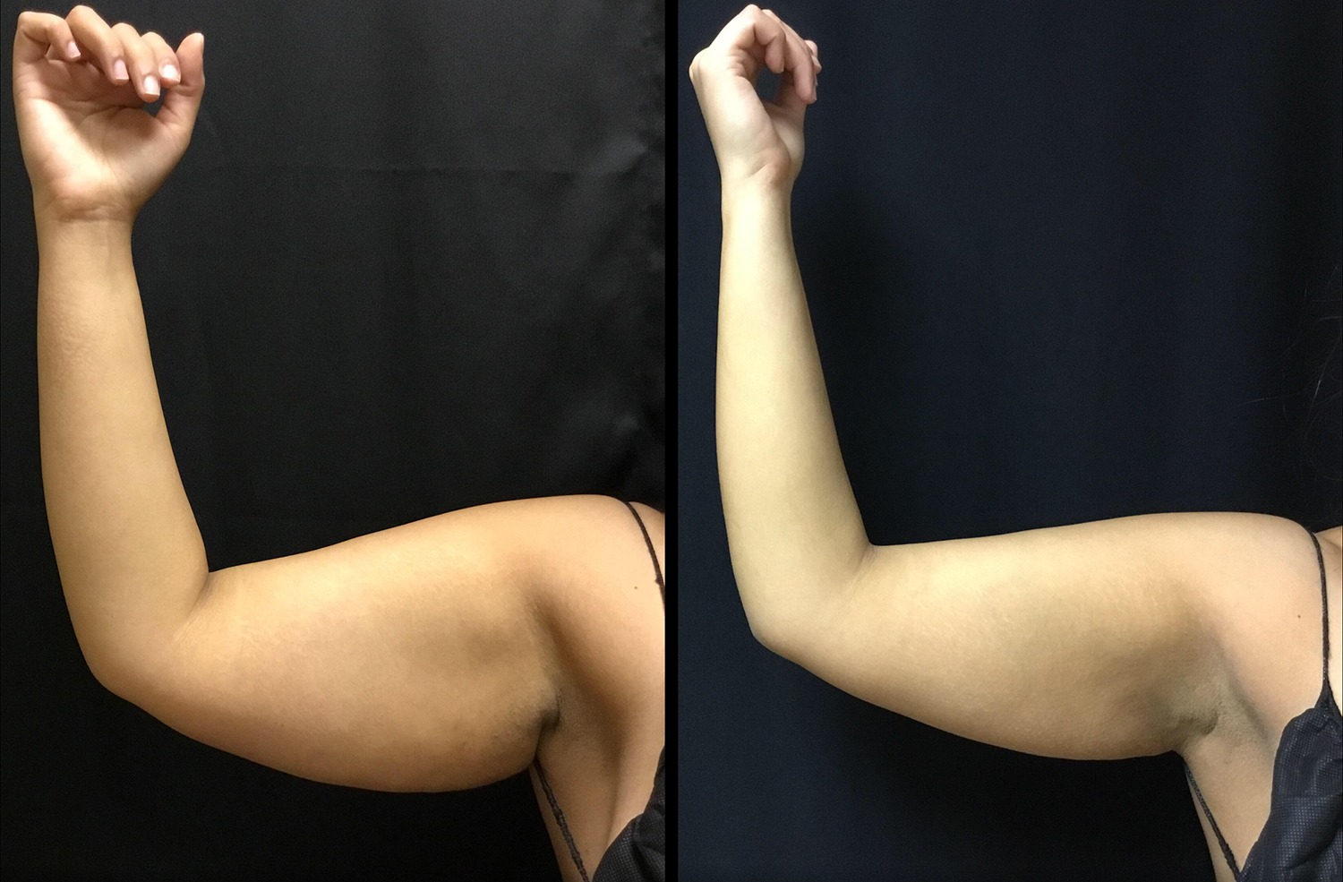 Scarless Armlift Before and After Photo by Dr. Hernandez in San Antonio Texas