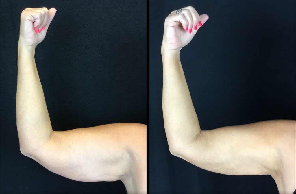 Scarless Armlift Before and After Photo by Dr. Hernandez in San Antonio Texas