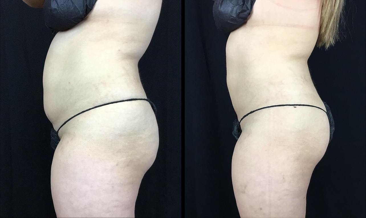 BodyTite Before and After Photo by Dr. Hernandez in San Antonio Texas