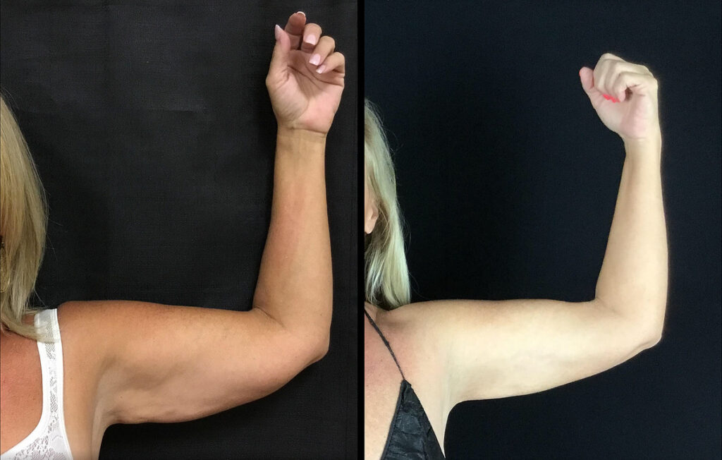 BodyTite Before and After Photo by Dr. Hernandez in San Antonio Texas