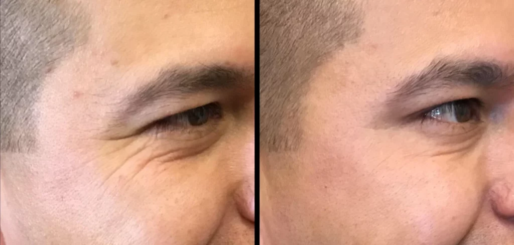 Botox Before and After Photo by Dr. Hernandez in San Antonio Texas