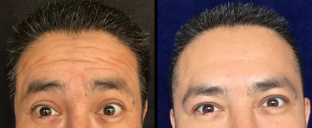 Botox Before and After Photo by Dr. Hernandez in San Antonio Texas