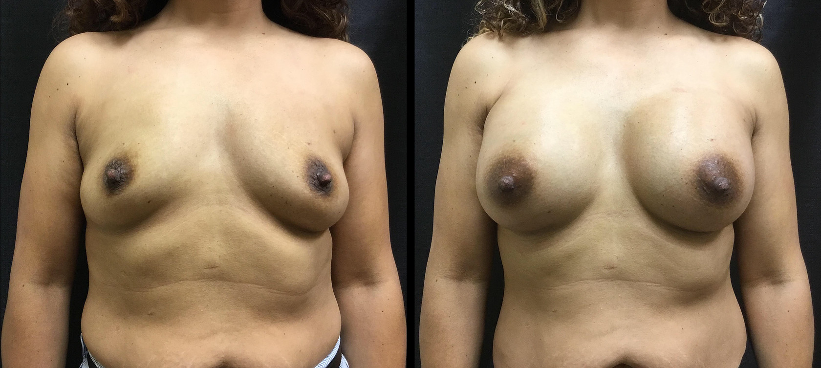 Breast Augmentation Before and After Photo by Dr. Hernandez in San Antonio Texas