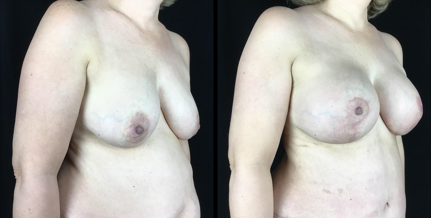 Breast Lift Before and After Photo by Dr. Hernandez in San Antonio Texas