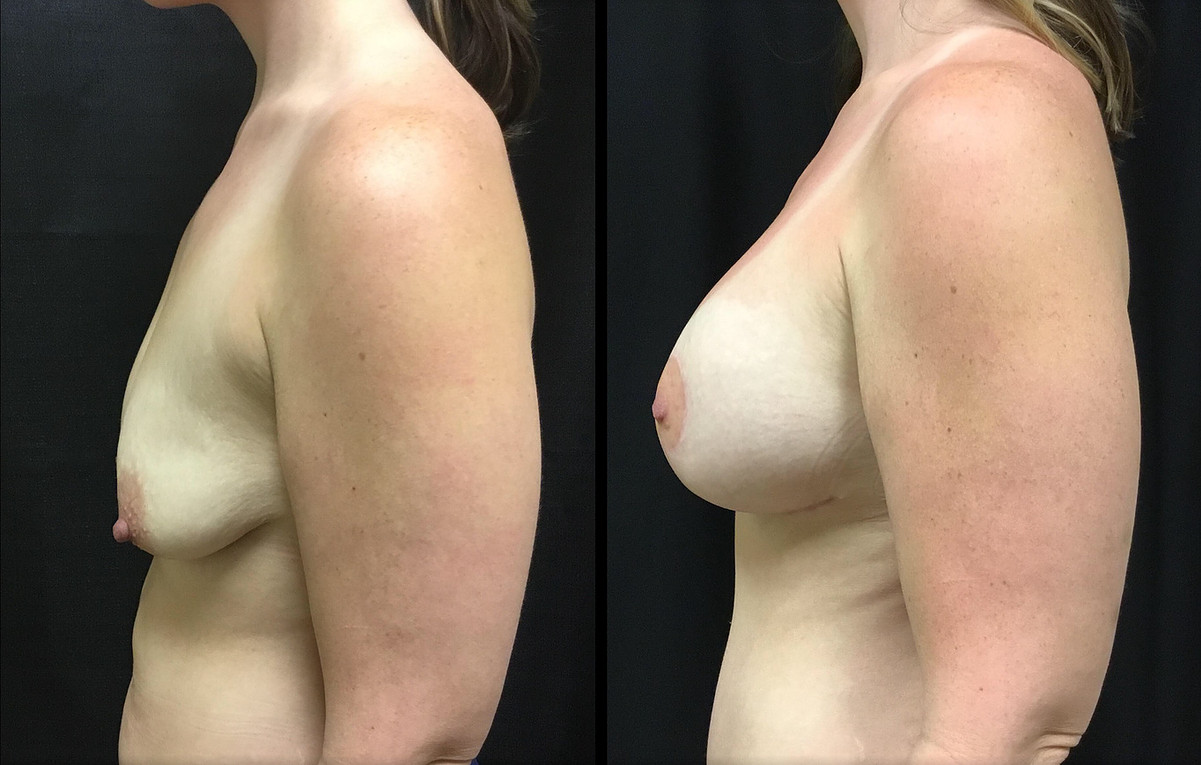 Breast Lift Before and After Photo by Dr. Hernandez in San Antonio Texas