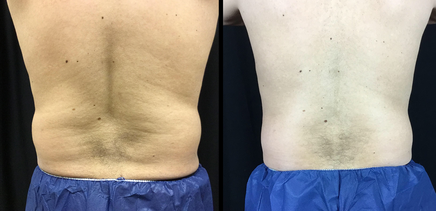 CoolSculpting Before and After Photo by Dr. Hernandez in San Antonio Texas
