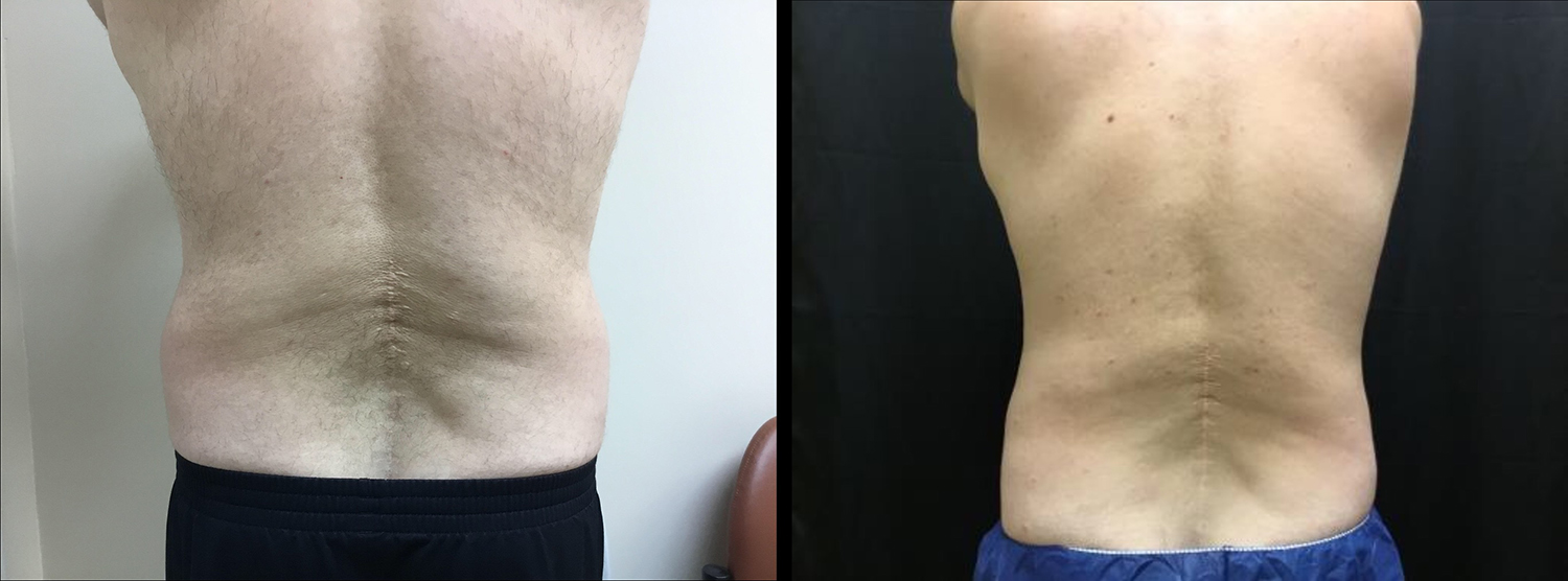 CoolSculpting Before and After Photo by Dr. Hernandez in San Antonio Texas