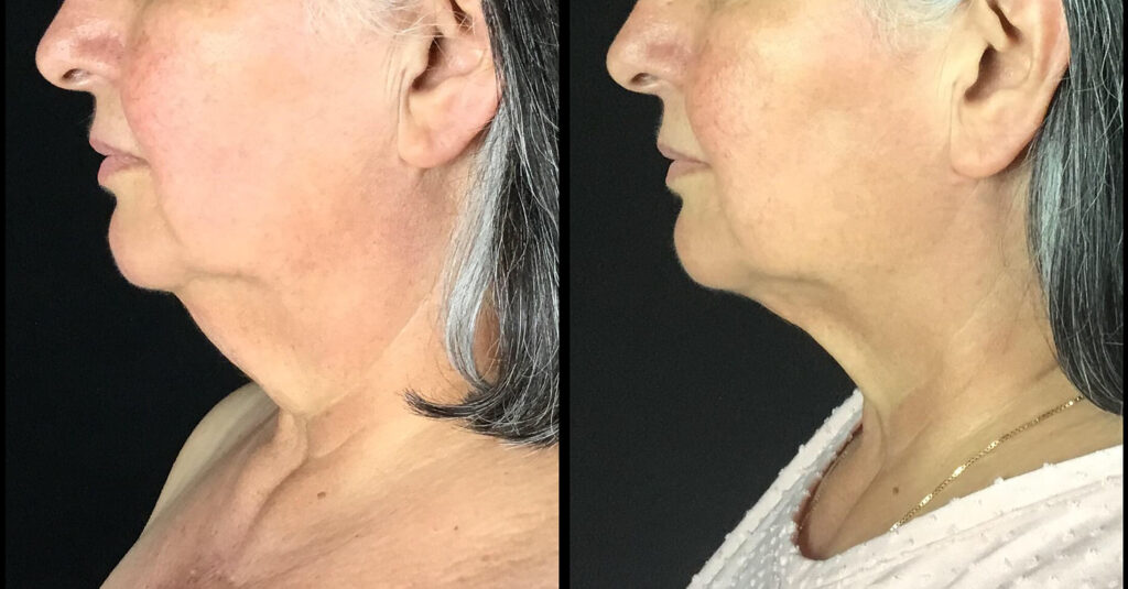 FaceTite Before and After Photo by Dr. Hernandez in San Antonio Texas