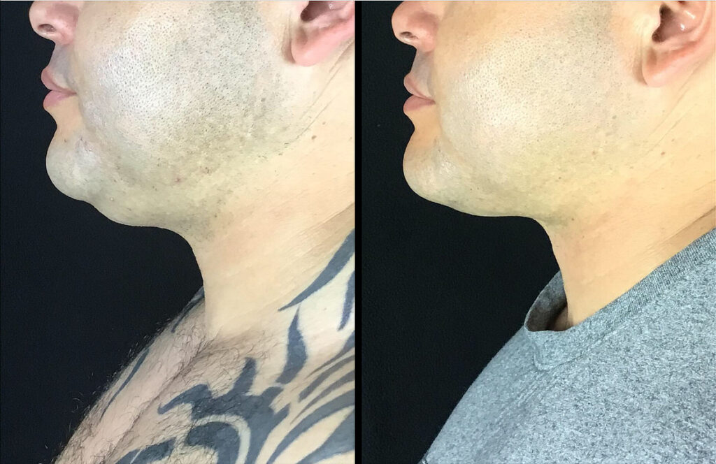 FaceTite Before and After Photo by Dr. Hernandez in San Antonio Texas