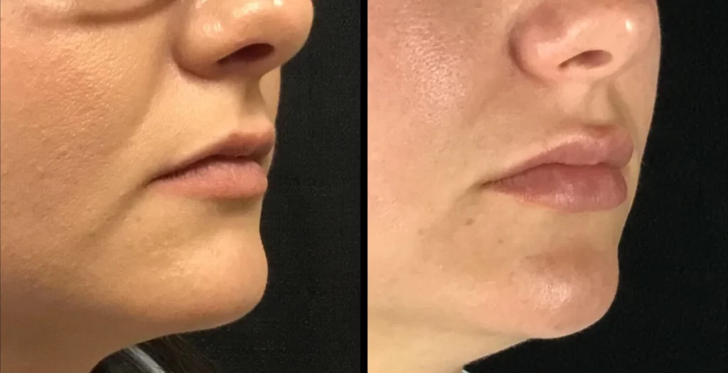 Juvederm Before and After Photo by Dr. Hernandez in San Antonio Texas