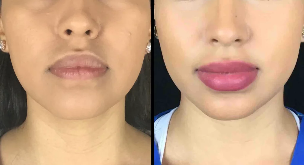 Juvederm Before and After Photo by Dr. Hernandez in San Antonio Texas