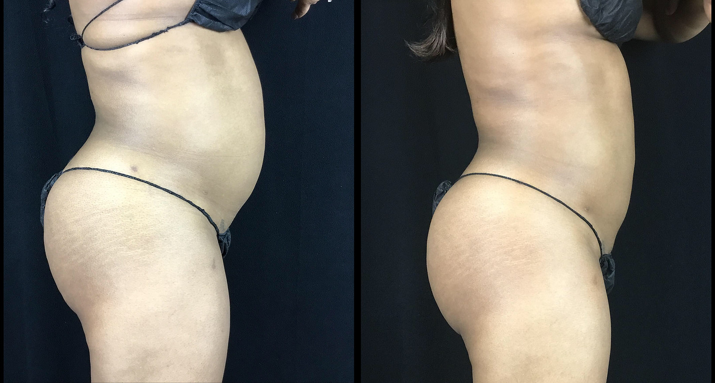 Liposuction Before and After Photo by Dr. Hernandez in San Antonio Texas