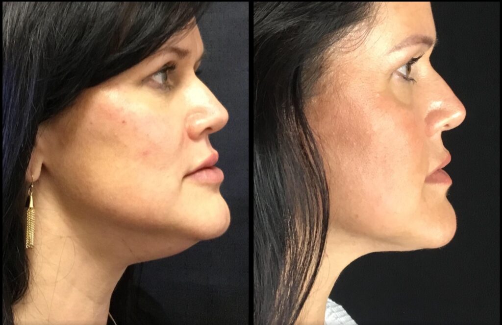 Kybella Before and After Photo by Dr. Hernandez in San Antonio Texas