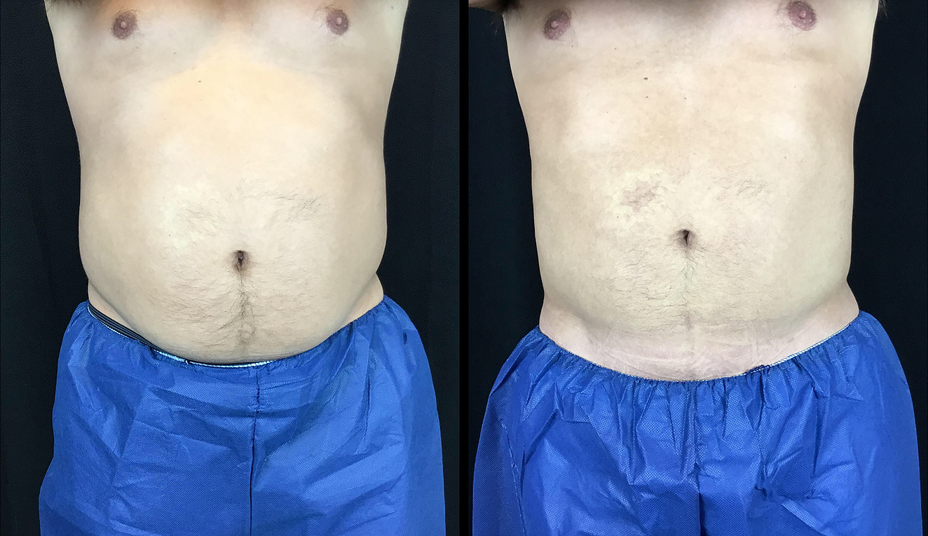 Liposuction Before and After Photo by Dr. Hernandez in San Antonio Texas