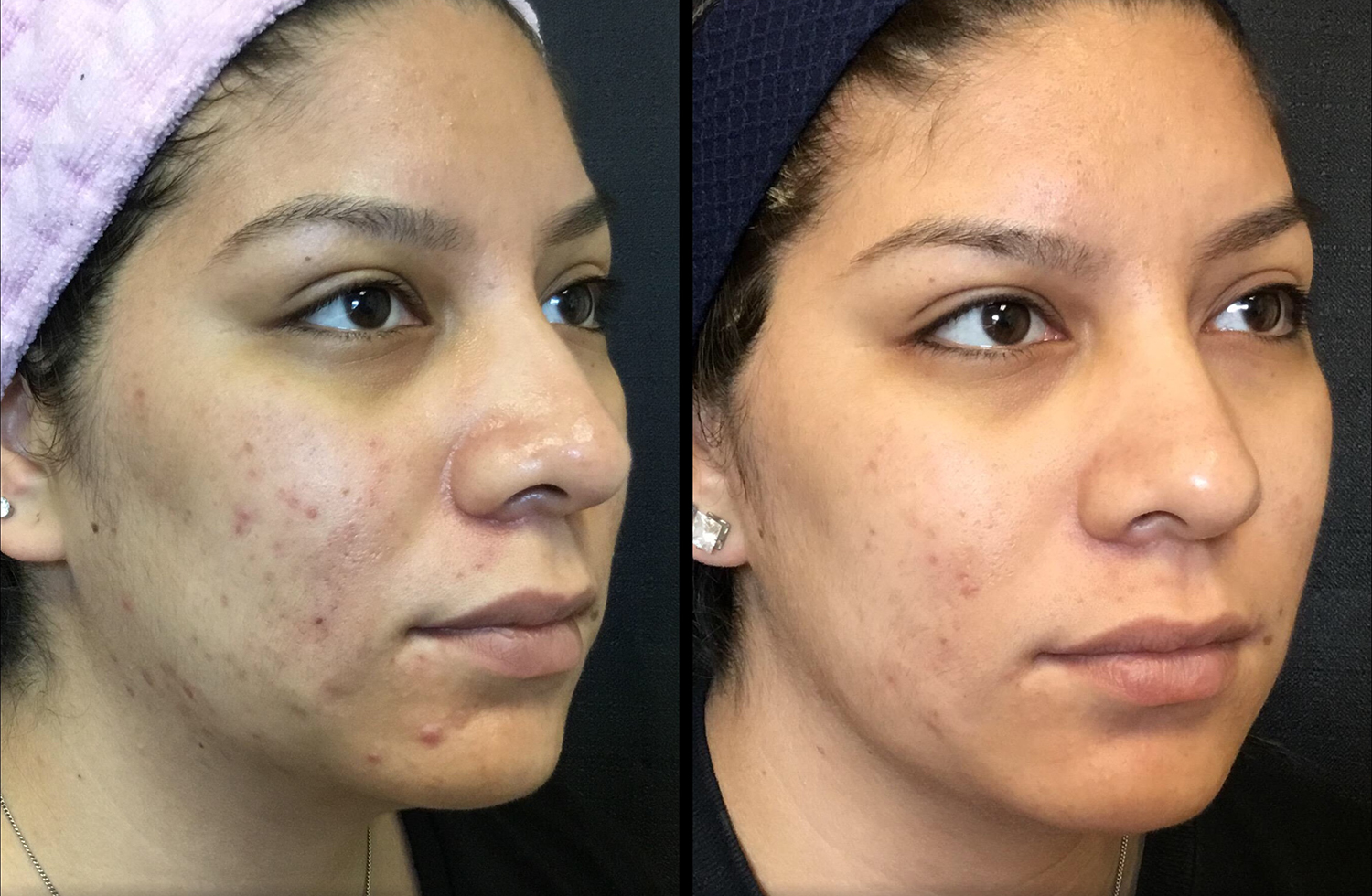 Microneedling Before and After Photo by Dr. Hernandez in San Antonio Texas