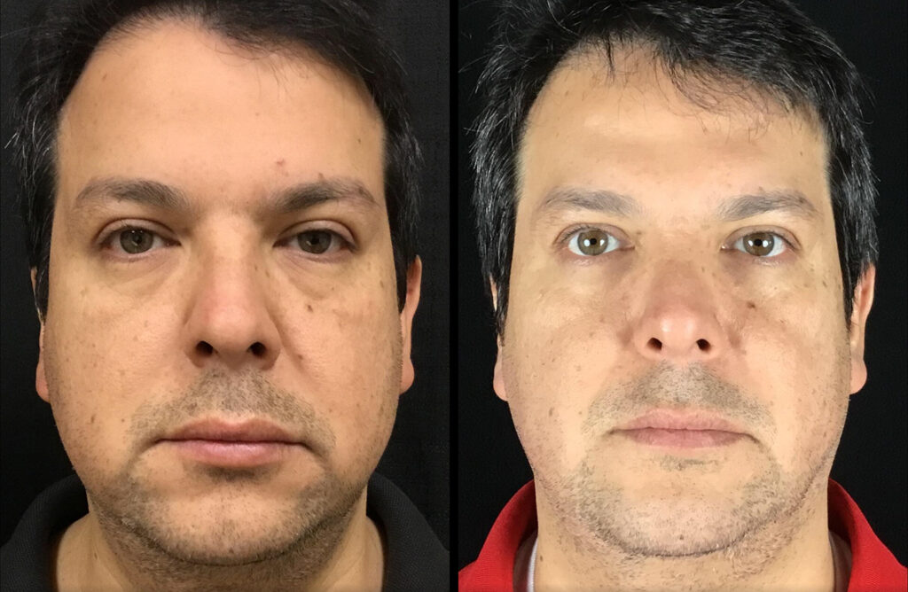 Microneedling Before and After Photo by Dr. Hernandez in San Antonio Texas
