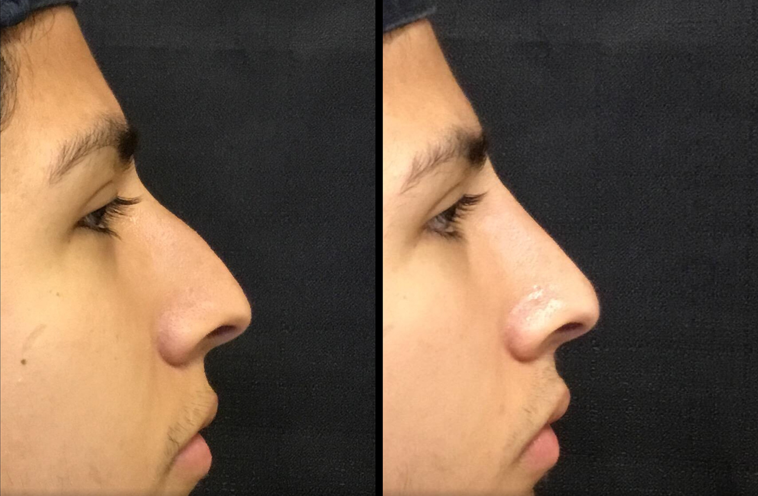 Nasal Contouring (Non-Surgical Rhinoplasty) Before and After Photo by Dr. Hernandez in San Antonio Texas