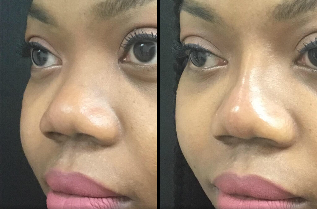 Nasal Contouring (Non-Surgical Rhinoplasty) Before and After Photo by Dr. Hernandez in San Antonio Texas