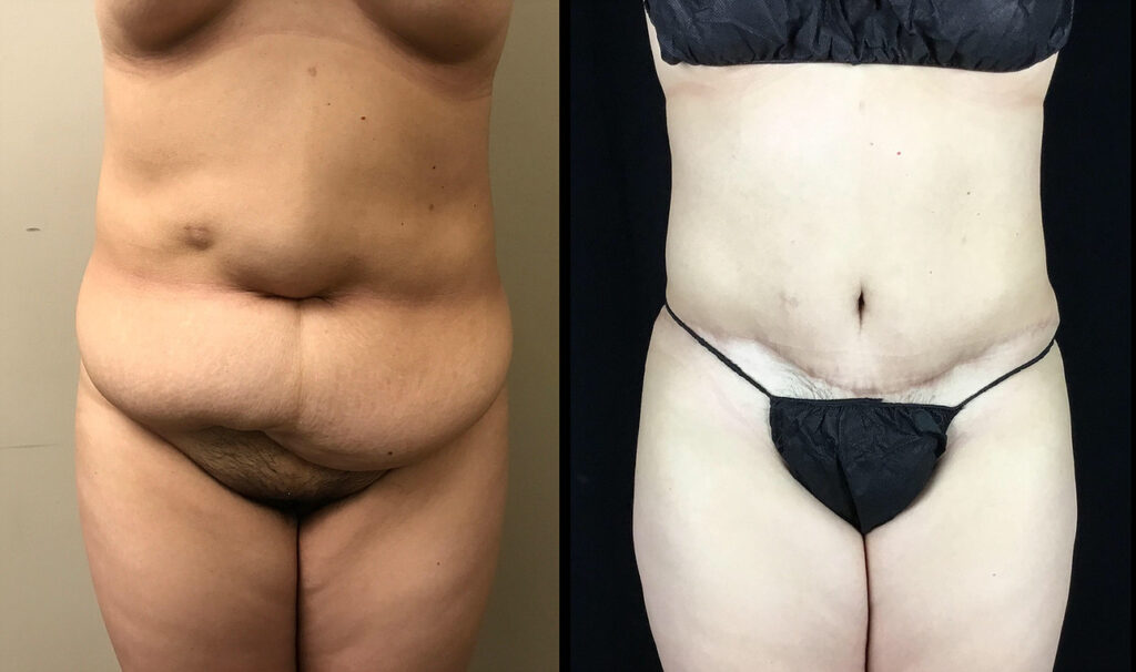 Tummy Tuck Before and After Photo by Dr. Hernandez in San Antonio Texas