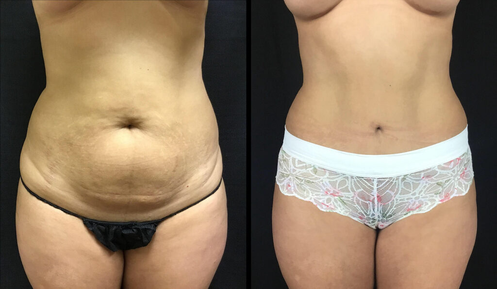 Tummy Tuck Before and After Photo by Dr. Hernandez in San Antonio Texas
