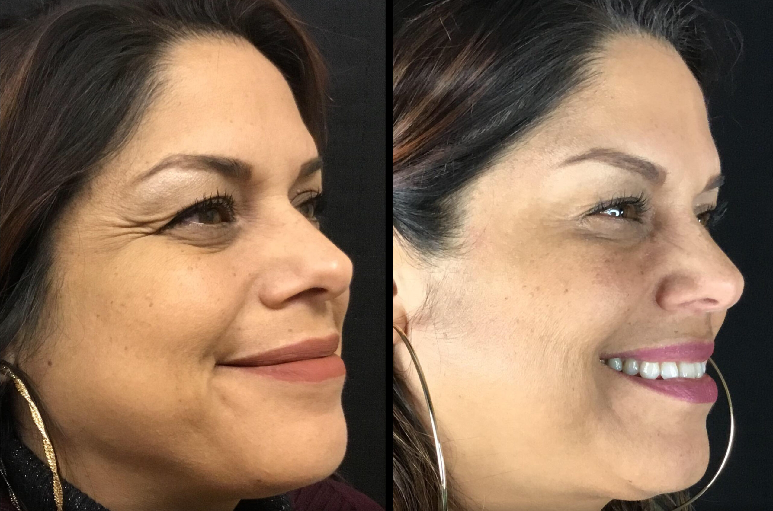Before and After botox Photo