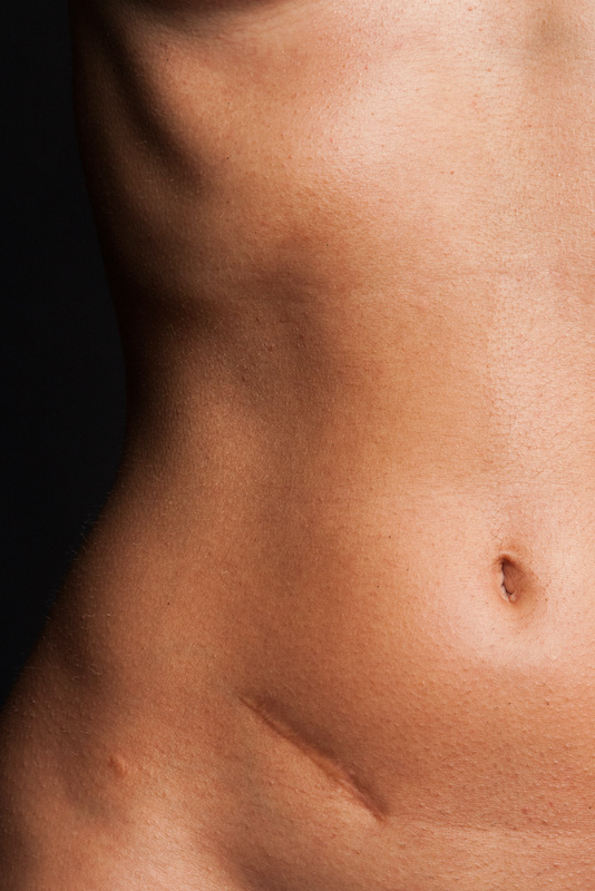 up-close image of scar on lower torso
