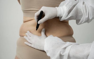Fat Transfer for Hip Dips: Can It Help Create a Curvier Silhouette?