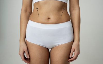 No-Cut Tummy Tuck vs. Traditional Tummy Tuck: Which Is Best for You?