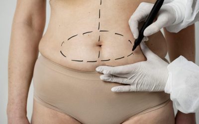 Is Liposuction 100% Safe? Knowing the Pros and Cons