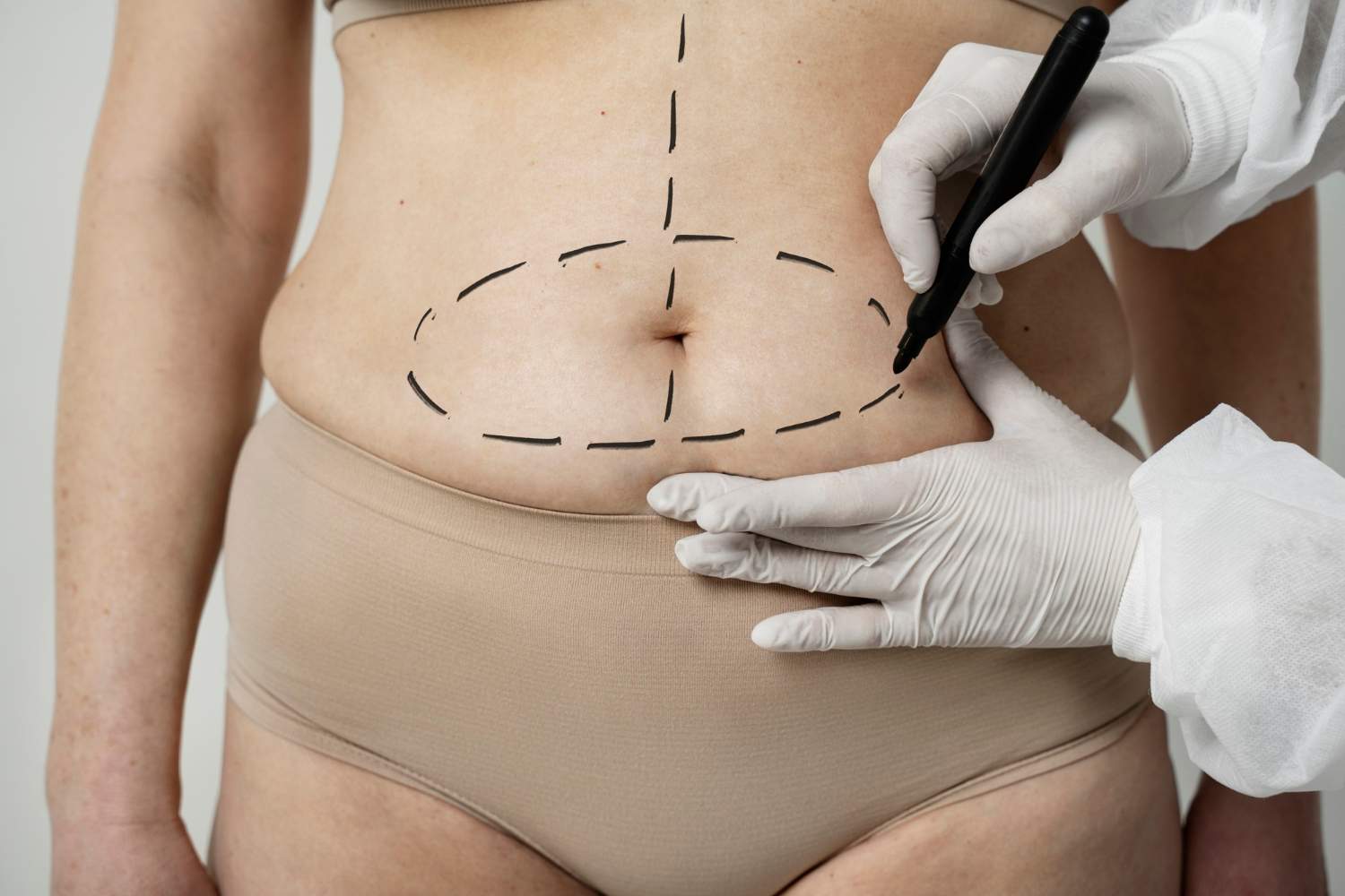 Is Liposuction 100% Safe – Eterna Cosmetic Surgery Is Liposuction 100% Safe - Eterna Cosmetic Surgery