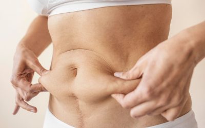 Top Non-Surgical Tummy Tuck Doctors in San Antonio, TX