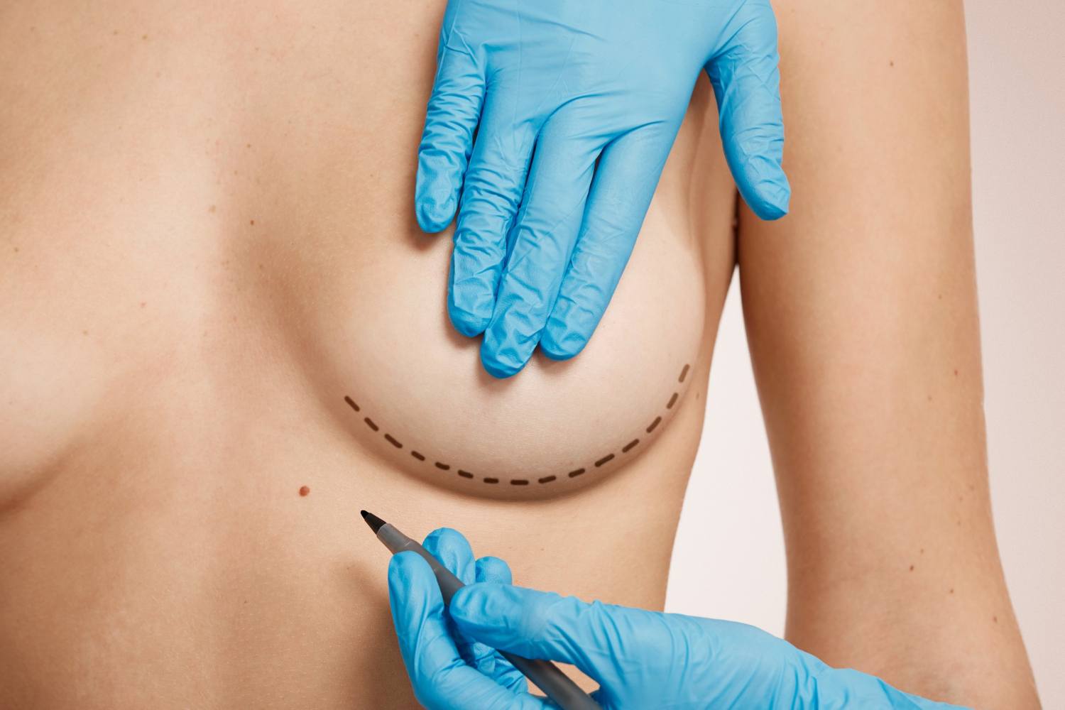 Breast Natural Augmentation – Fat Transfer Safety – Eterna Cosmetic Surgery Breast Natural Augmentation - Fat Transfer Safety - Eterna Cosmetic Surgery
