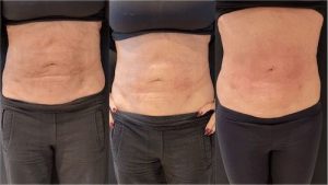 Before After Aspen Fibrosis Treatment - Eterna Cosmetic Surgery