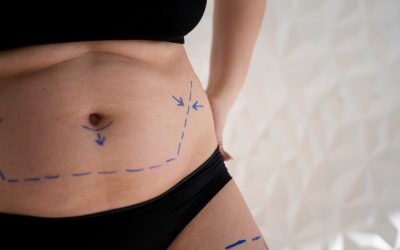Could Aspen Fibrosis Treatment Help Your Liposuction Recovery?