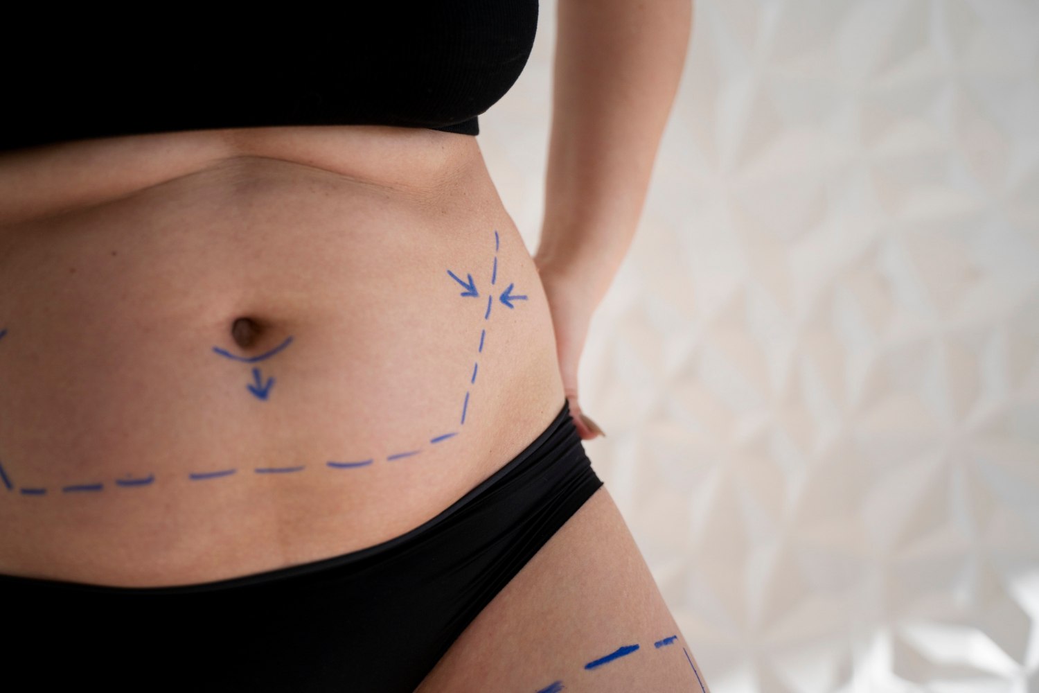 Could Aspen Fibrosis Treatment Help Your Liposuction Recovery - Eterna Cosmetic Surgery